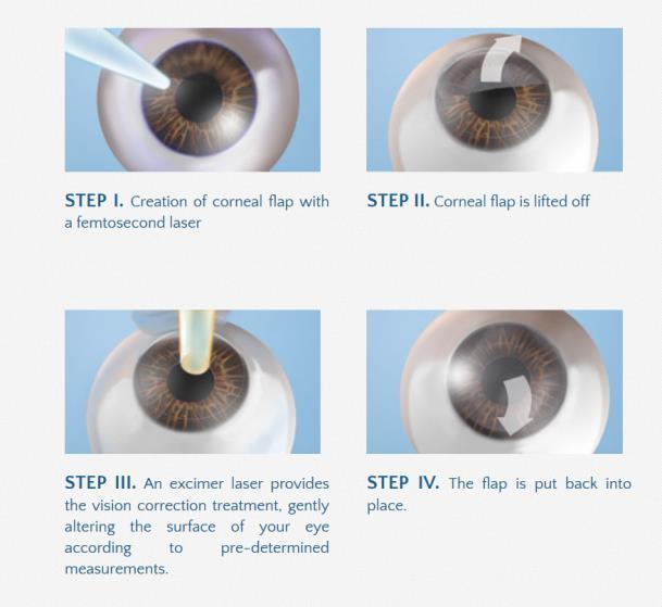 lasik surgery bladeless http://www.manneye.com/blade-free-lasik-houston/ 71 visual disorders of the eye (from outline) 5. What are the following optical and organic visual disorders: a. emmetropia g.