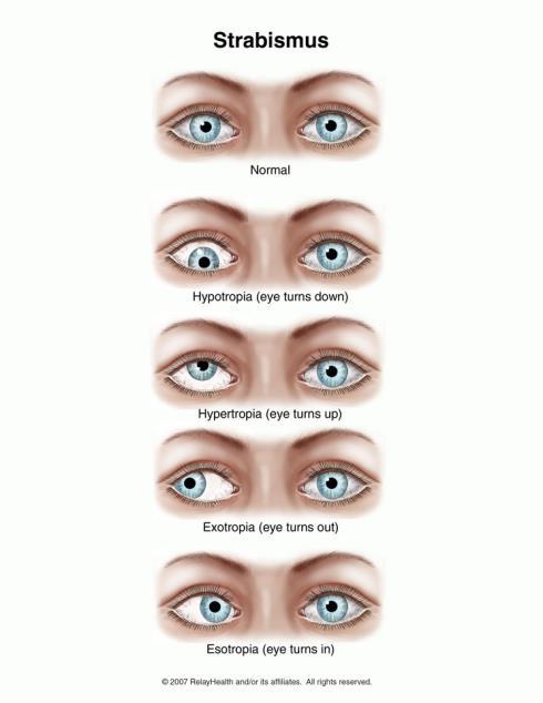 VISUAL DISORDERS SARAH THORNBURG CROWN 85 VISUAL PERCEPTION STRABISMUS What is it? When both eyes are not aligned and so look in different directions. What are the symptoms?
