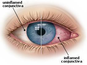 CONJUNCTIVITIS What is it? The inflammation or infection of the conjunctiva or the outer layer of the eye and the inner eyelid, commonly referred to as pink eye.