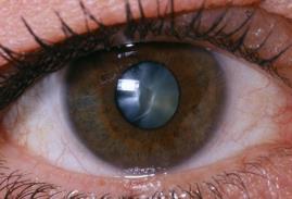 Pinkeye is most routinely contracted through a viral or bacterial infection, an allergic reaction, or a substance that can cause eye irritation such as contact solution or eye ointments.