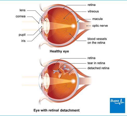 A tearing or separation of the retina, the light sensitive lining at the back of the eye, from the underlying tissue. What are the symptoms?