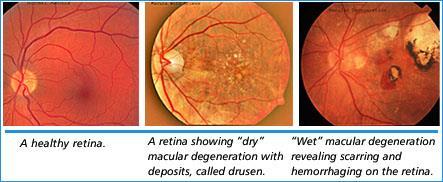 corner of you eye. What causes it? When a diabetic s blood pressure remains high for too long it can damage the blood vessels in the retina. How should we treat it?