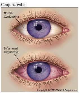 keratoconus conjunctivitis (conditions known as pink-eye ) http://www.