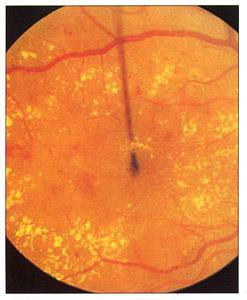 diabetic retinopathy Blood