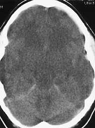 Cerebral Edema Loss of cisterns Loss of gray-white differentiation Diffuse hypodensity CSF appears