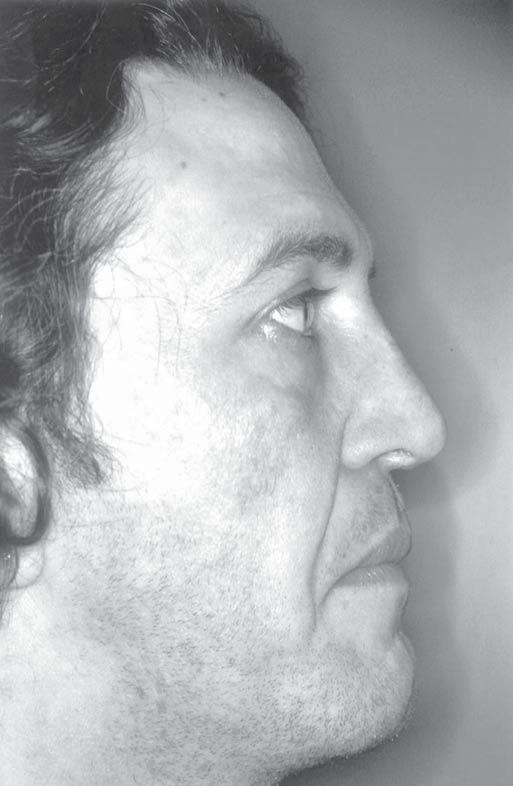 Boccieri Annals of Plastic Surgery Volume 52, Number 4, April 2004 The positive aspects of the technique are discussed, together with the results obtained with 24 hospital patients. FIGURE 15. Case 2.