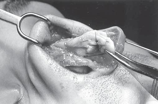 Annals of Plastic Surgery Volume 52, Number 4, April 2004Reconstruction of the Nasal Septum Using a Conchal Reshaped Graft F5-6 F7 also be separated, proceeding from the front to the rear.