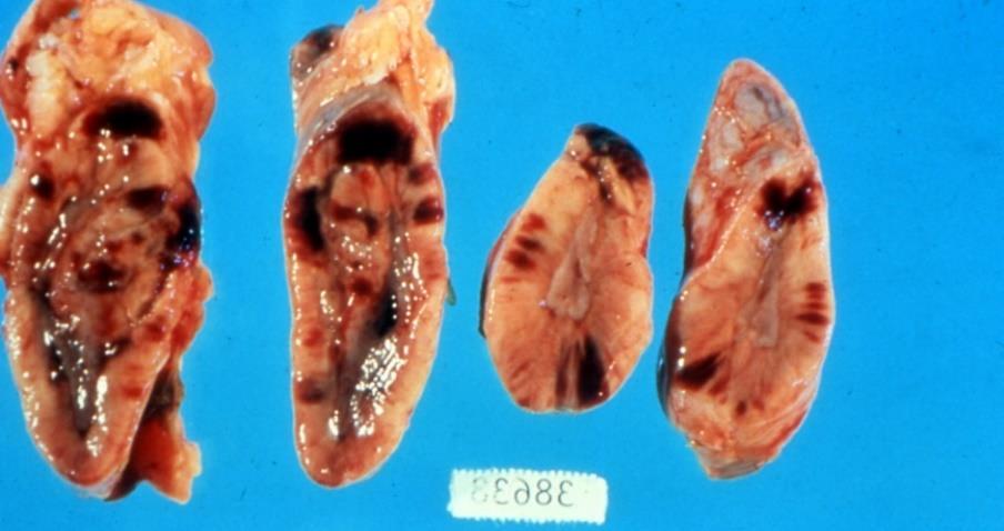 cell death Kidneys - acute tubular