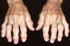 Osteoarthritis - hands