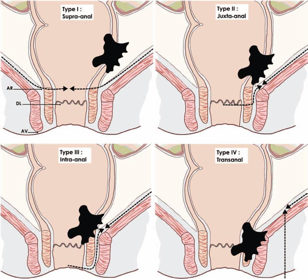 Low rectal cancer Classification and standardization of surgery Rullier et al.