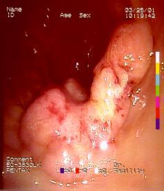 colectomy Extended resections Small bowell Abdominal wall Duodenum/pancreas