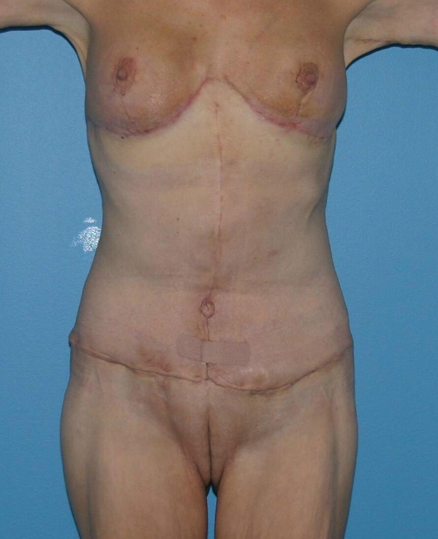 PTS T-Incision