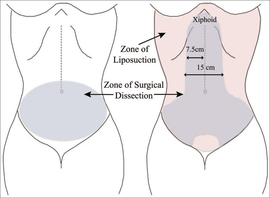 Liposuction & Abdominoplasty Rethink Matarasso s classification
