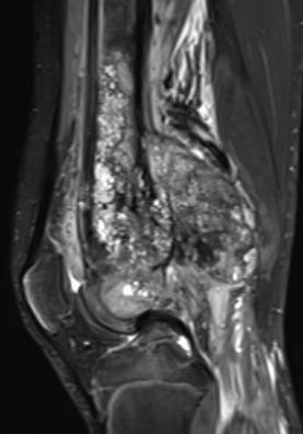 COG* imaging guidelines for Osteosarcoma Site Presentation / Pre-op Post-op, On ChemoRx Surveillance off Rx Primary tumor AP, lat XR MR + contrast XR q 16 wks MR (unless precluded by hardware) XR q3