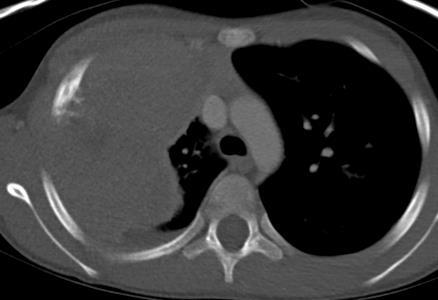 COG* imaging guidelines for Ewing Family of Tumors Site Presentation + prior to local control On ChemoRx, post local control Surveillance off Rx Primary tumor AP, lat XR MR + contrast XR ½ way thru