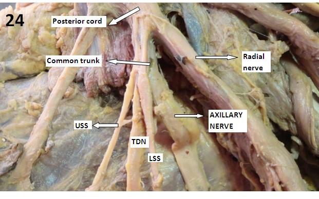 Axillary nerve is one of the most important nerves which is prone for iatrogenic injuries.