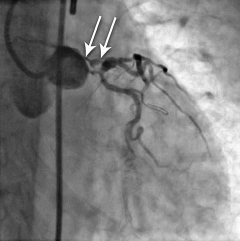 Right anterior oblique projection of the left coronary artery, showing total occlusion of the left main artery. Figure 4.
