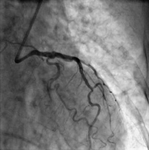 coronary artery, and revealing the left main artery stenosis. Figure 5.