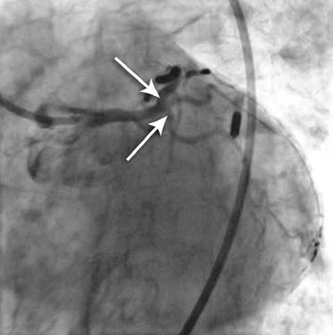 Primary PCI in Left Coronary Artery Occlusion Figure 6. Left anterior oblique projection of the left coronary artery, caudally angulated (spider view); final result after the successful intervention.