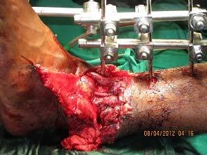 2). The amputated part was then replantated with one arterial and one