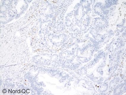 4b. Fig. 4b (x100) Insufficient staining reaction for S100 of the colon adenocarcinoma, using same protocol as in Figs. 1b - 3b same field as in Fig. 4a.