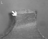 Adhesive/Cohesive Surface totally or partially covered by the adhesive. Cohesive on Resin Surface totally or partially covered by resin. Identification of the interface from the lateral view ( ).