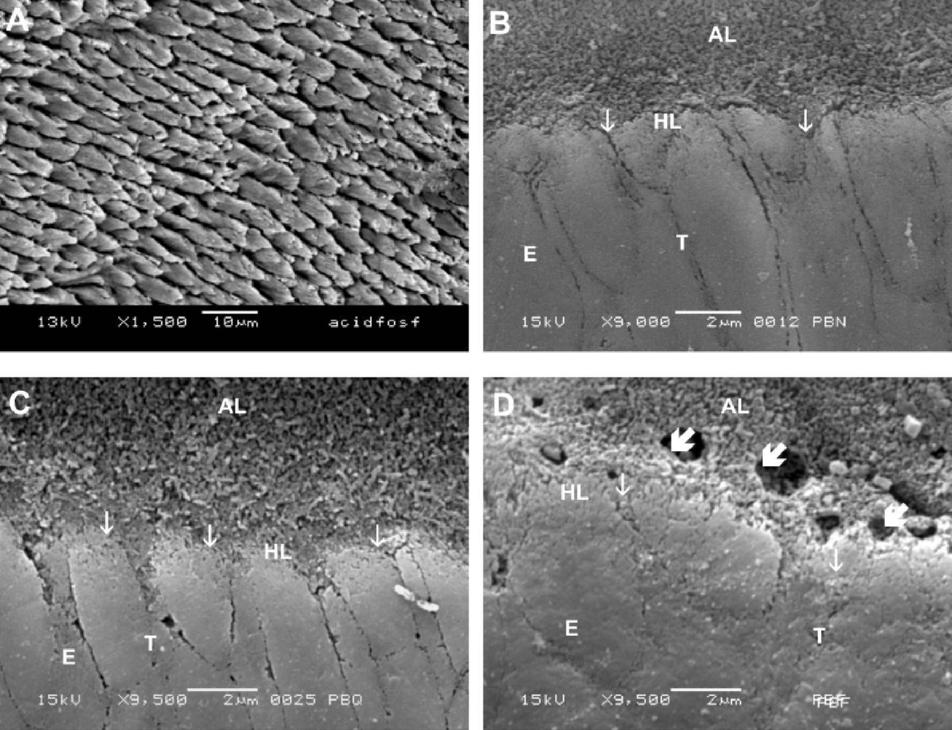 The adhesive APR presented a high incidence of cohesive adhesive fractures at all temperatures. However, the application of APR-H was related to a relevant amount of enamel fracture.