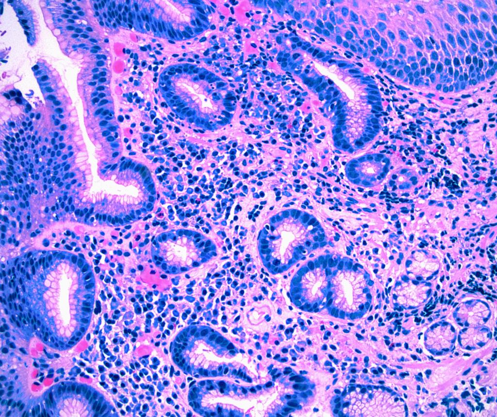 Anatomic Pathology / ORIGINAL ARTICLE A B When organisms were identified by immunohistochemical analysis, irrespective of biopsy site, they had a cumulative inflammatory score of 2 or more (Figure 3).