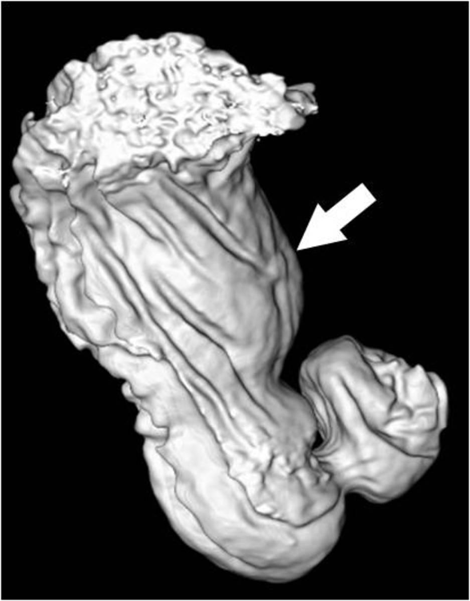 Fig. 3: T1 stomach cancer in a 3D