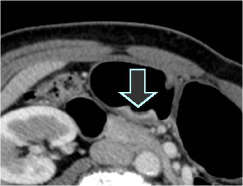Fig. 5: T2 stomach cancer