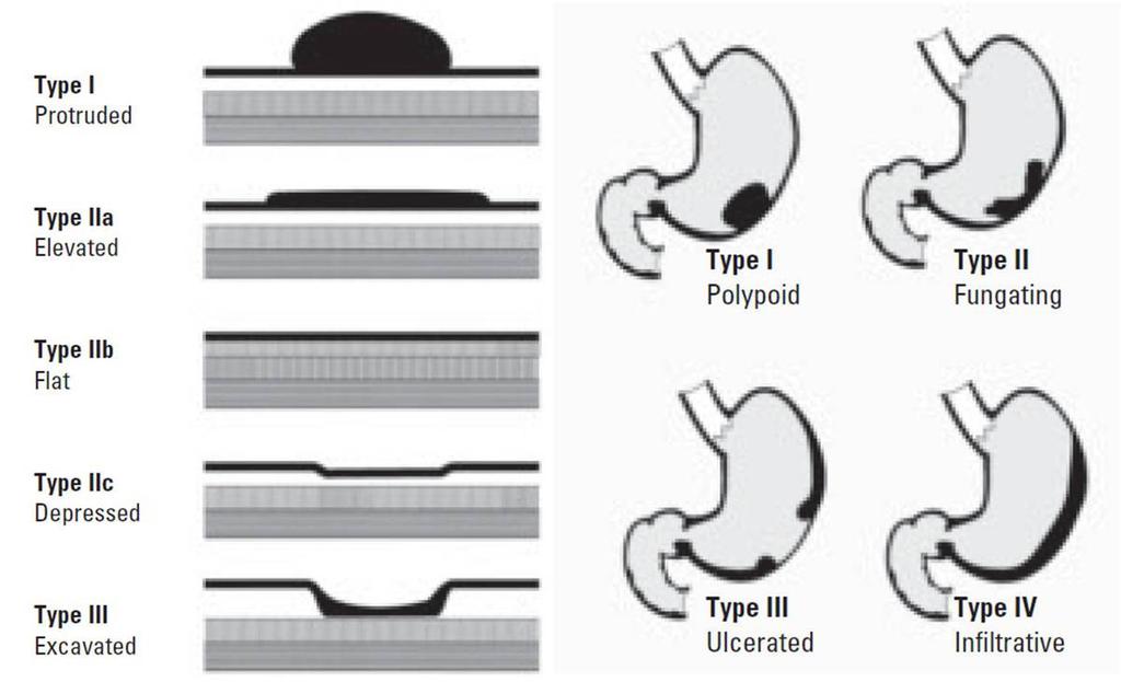 Fig. 11: Morphologic classification of stomach cancer