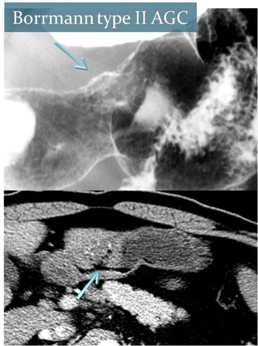 Fig. 14: Barium study and a CT image