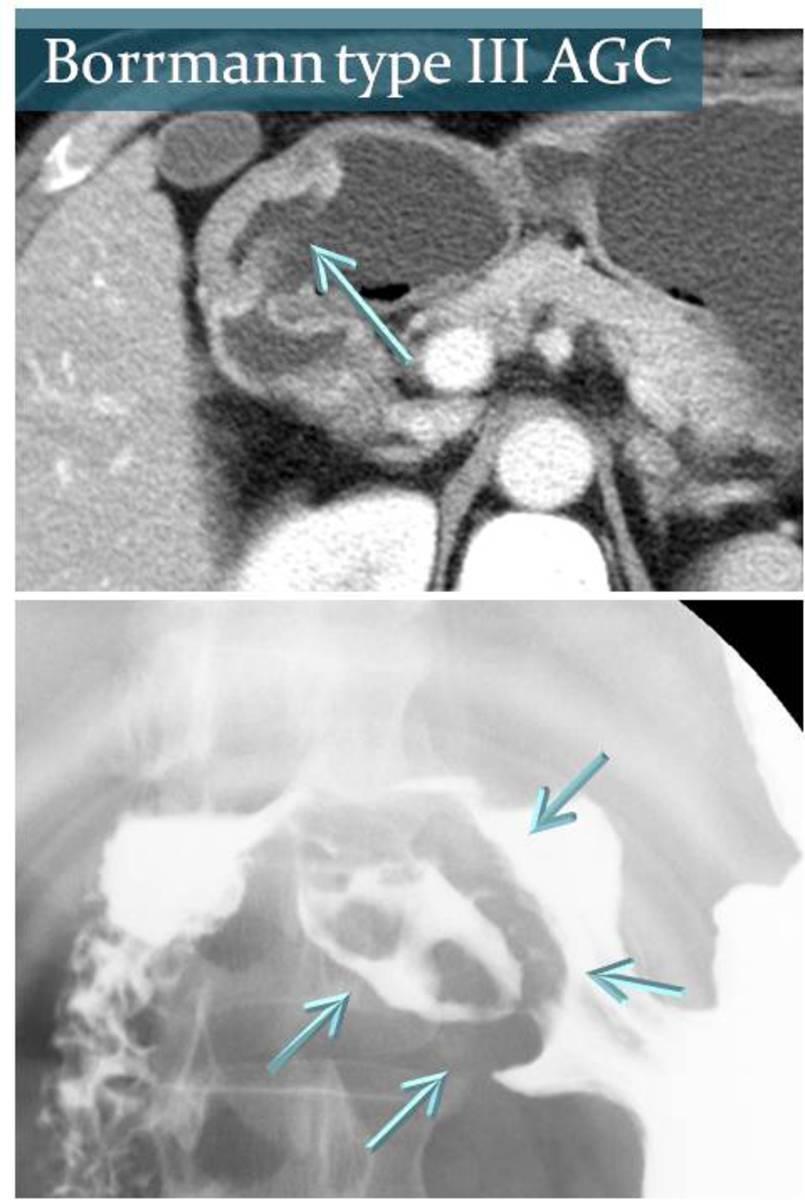 Fig. 15: A CT image and barium study
