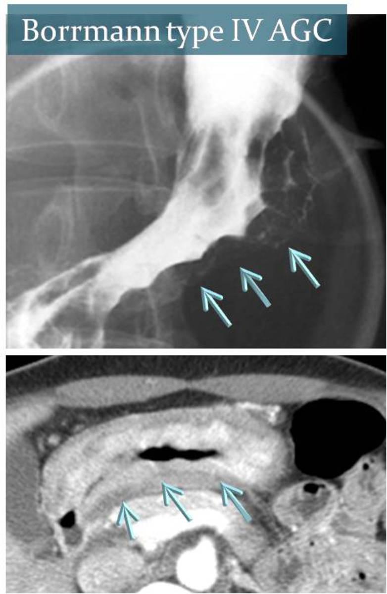 Fig. 16: Barium study and a CT image