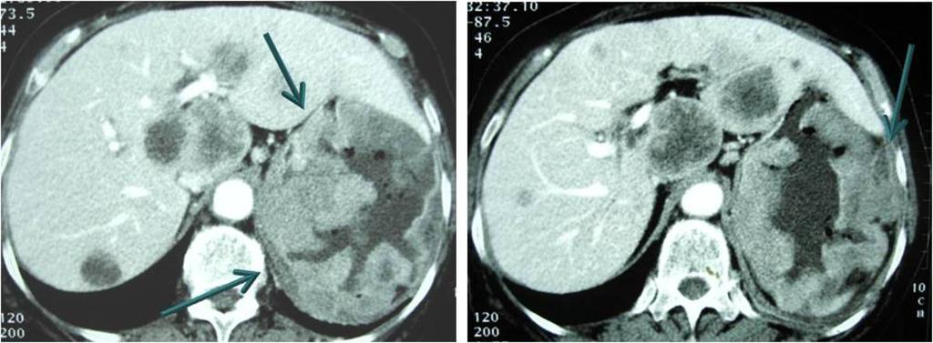 Submucsal tumor spread shows prominent contrast enhancement on CT scans.