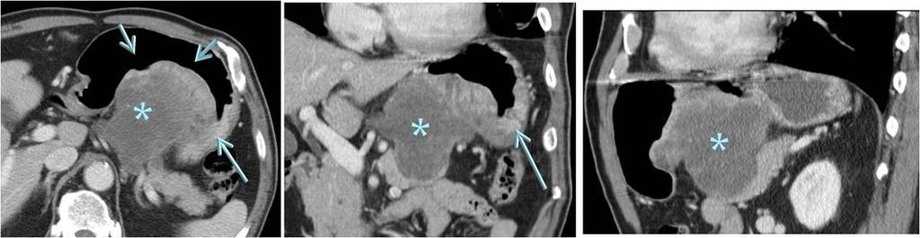 Fig. 25: A rapidly growing subepithelial tumor of the gastric cardia in a 82 year-old man, which was confimed as a poorly