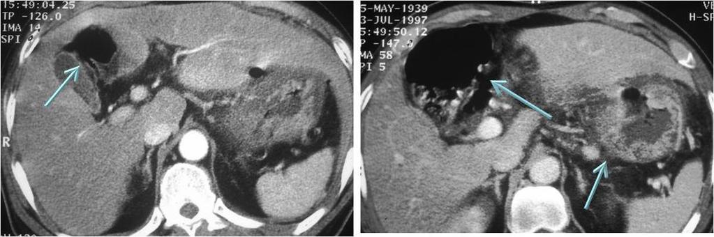 Fig. 33: A 68-year old woman with AGC at the lower body (small arrow).