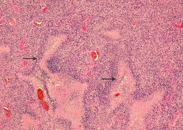 Glioblastoma - Histology What is Glioblastoma, what does it look like?