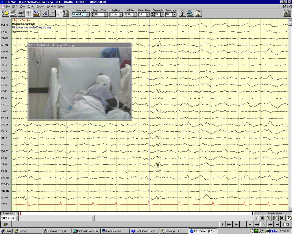 flailing, arrhythmic especially during sleep; patients in fugue states can be fully ambulatory but clearly confused;