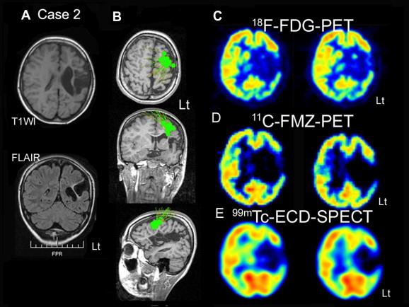 PET Scans : Sensitive to Chronic Hypo- Perfusion Imaging Approaches CT has largely