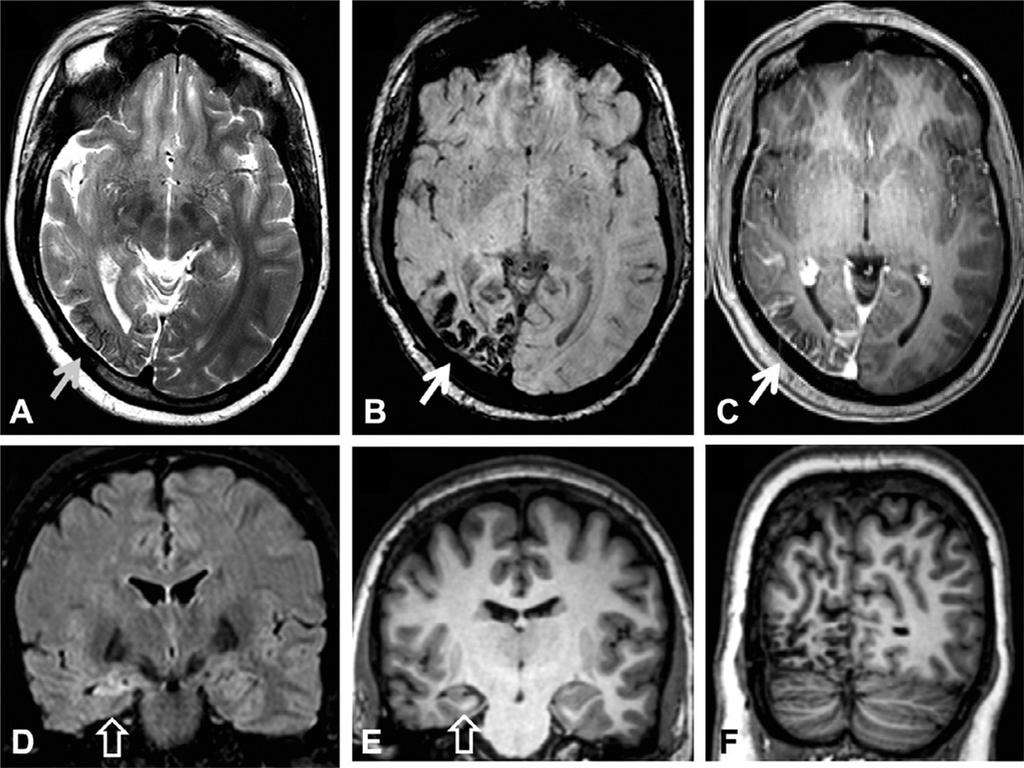 physiological changes To these modalities have been added MRI morphometry, diffusion
