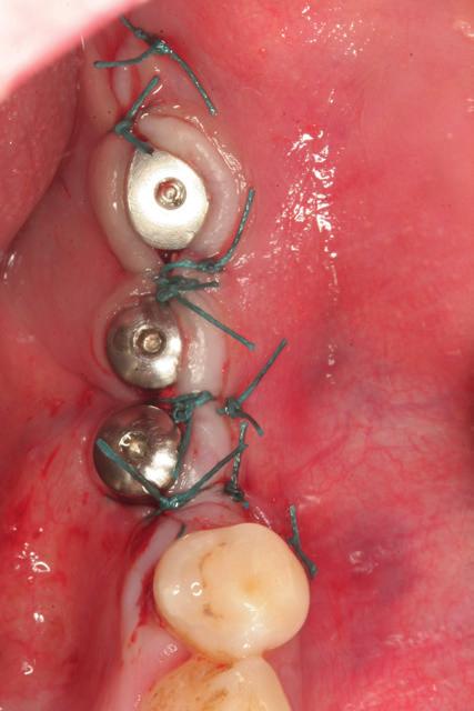 GBR with a nonsubmerged approach Figs. 1G J G H I J Figs. 1K & L K L maintenance. Patients were not allowed to use removable prostheses for 3 weeks after bone grafting surgeries.