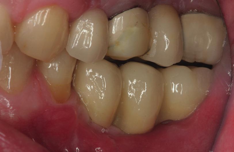 Defects were measured using a millimetric periodontal probe (UNC, Hu-Friedy, Chicago, Ill., U.S.) placed parallel or perpendicular to the long axis of the implant.