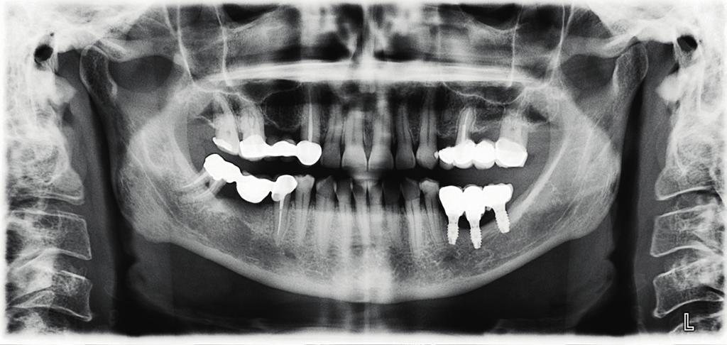 Radiographic periimplant marginal bone loss: Intraoral radiographs were taken at the moment of prosthetic loading (baseline), 1 year post- loading and 3 years post-loading (control radiographs),