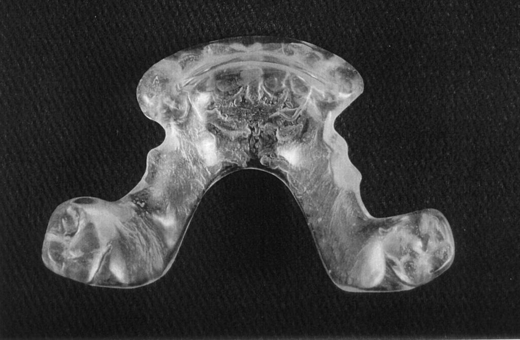 Gelb 14 notes that the mandibular orthopedic repositioning appliance, which is constructed to cover only the lower posterior teeth has a lot of advantages: 1.