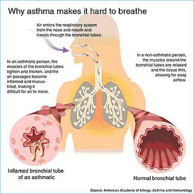 Asthma Strongly associated with allergic