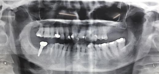 alveolar bone, absence of periapical pathology. After administering appropriate antibiotic and analgesic, induction of local anaesthesia was carried out using lignocaine with adrenaline.