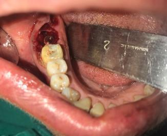 The clinical and radiographic examination reveals grossly decayed tooth.