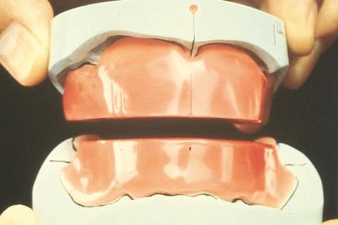 When the upper rim (aesthetic control base [ACB]) has been formed, and prescribed to suit the patient, the lower rim is placed in the mouth and trimmed until it contacts the upper rim evenly in RCP,