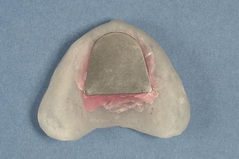 one for each arch, both mounted on rigid stable bases, usually made of light-cured polymethylmethracylate (PMMA). The upper apparatus comprises a metallic plate that spans the maxillary arch.